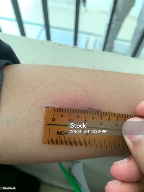 positive skin tb test image.